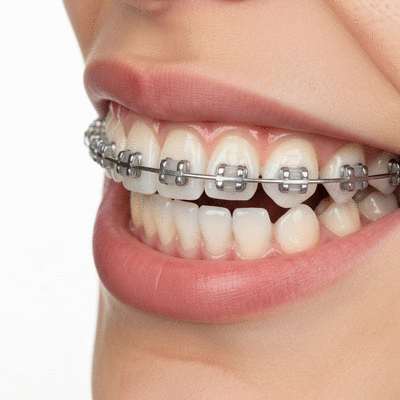 Close-up of a patient's mouth with ceramic braces, highlighting their discreet appearance