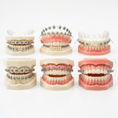 Gros plan sur des modèles de dents avec des appareils orthodontiques variés