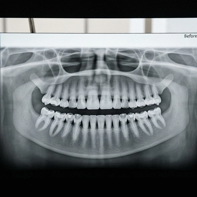 Close-up of a dental model or x-ray showing teeth alignment issues before orthodontic treatment