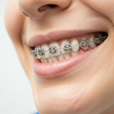 Close-up of a person with metal braces, showing the intricate details of the orthodontic appliance on teeth, in a clean, professional dental setting.